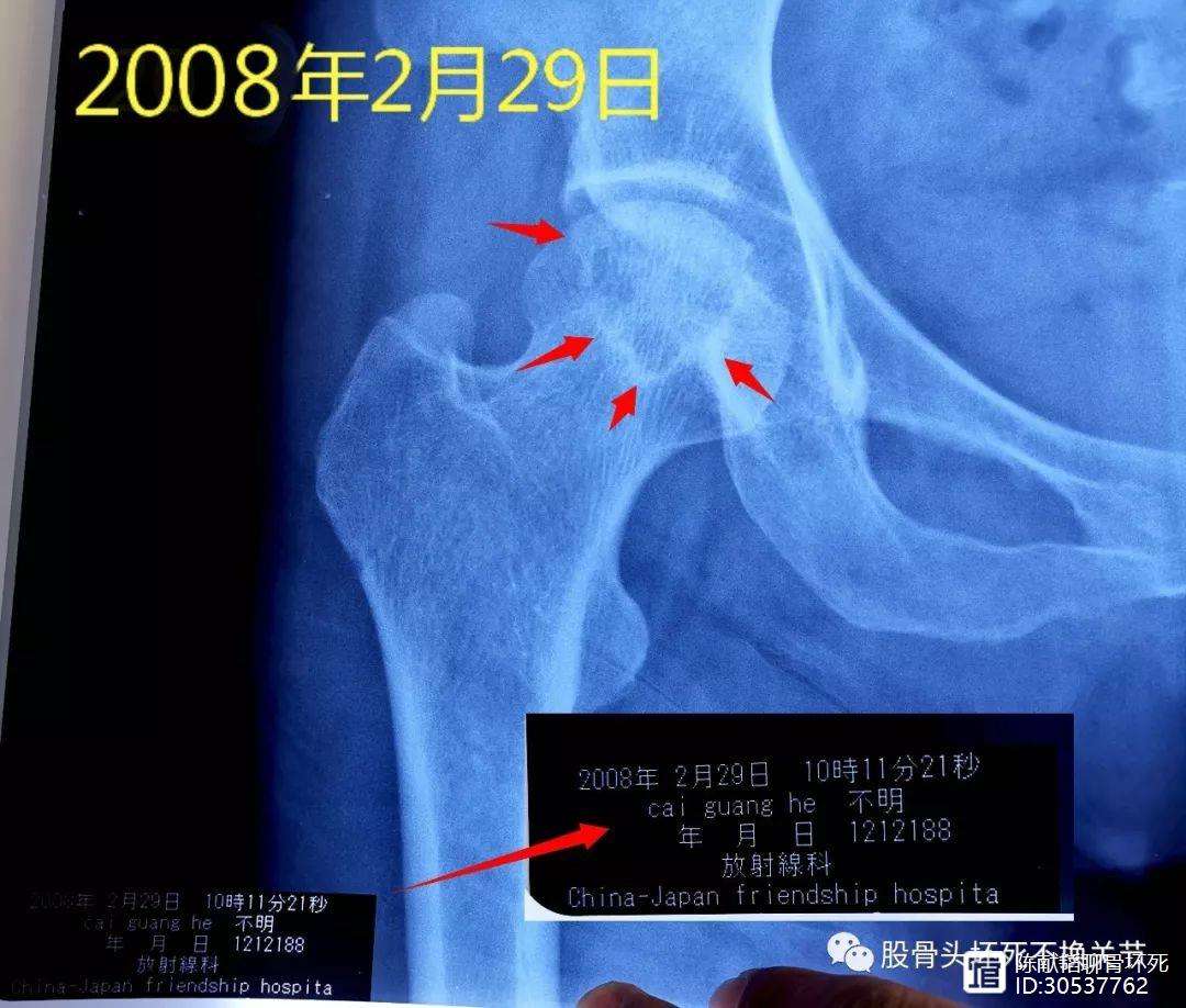 石家庄人工骨头医保报销多少(人工骨头医保报销多少比例)